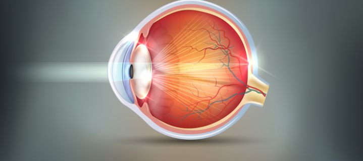 Schnittbild eines Auges mit Linsentrübung (Katarakt)